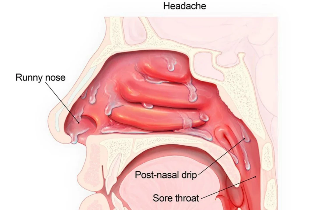 Bromhexine: A Solution for Post-Nasal Drip and Persistent Cough